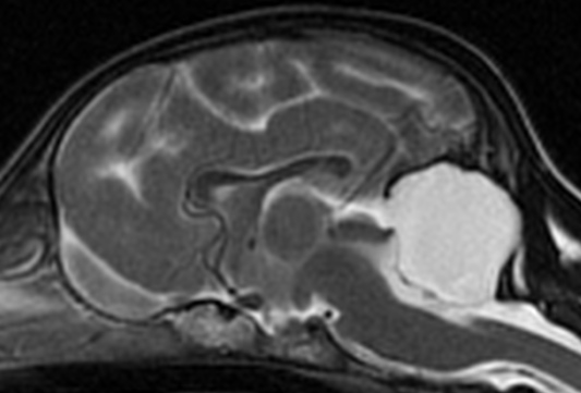 MRI - Cerebellar Aplasia