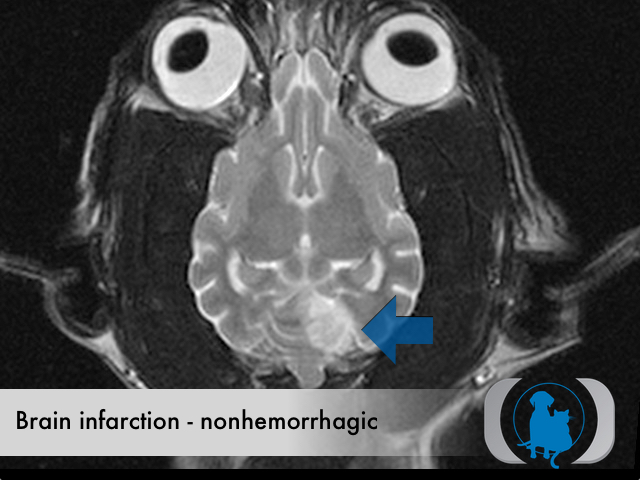 Brain infarction nonhemorrhagic