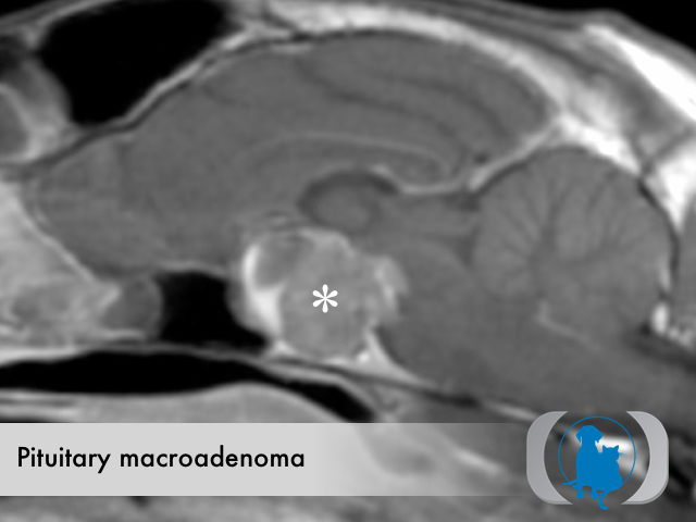 Pituitary macroadenoma