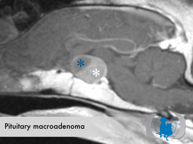 Pituitary macroadenoma