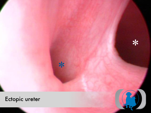 Ectopic ureter