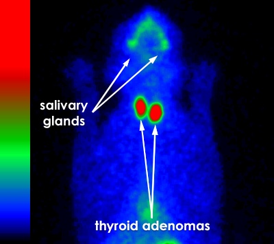 thyroid scintigraphy hyperthyroid cat bilateral adenomas