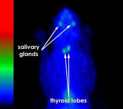 thyroid scintigraphy normal