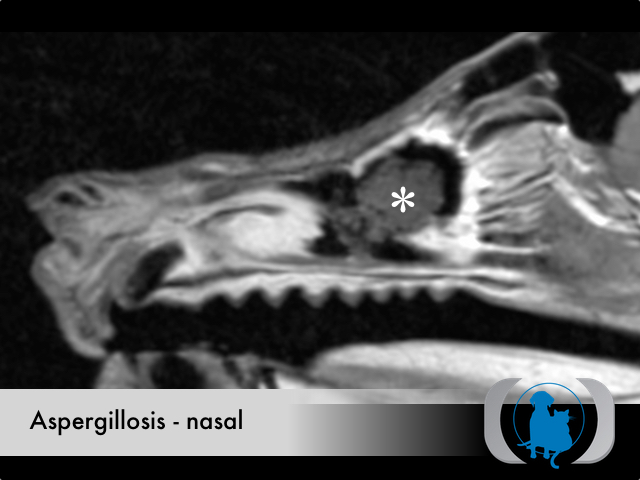 Aspergillosis nasal - MRI