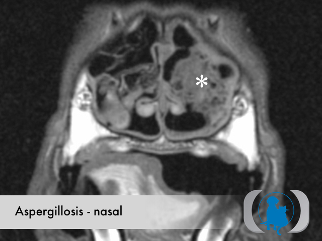 Aspergillosis nasal - MRI