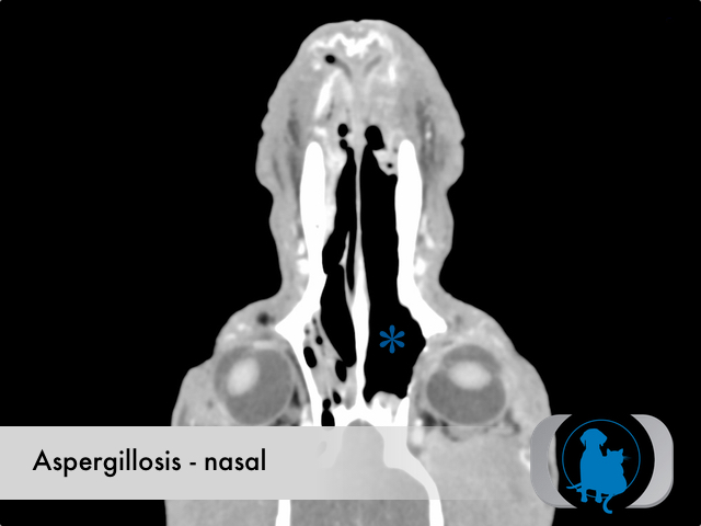 Aspergillosis nasal - CT