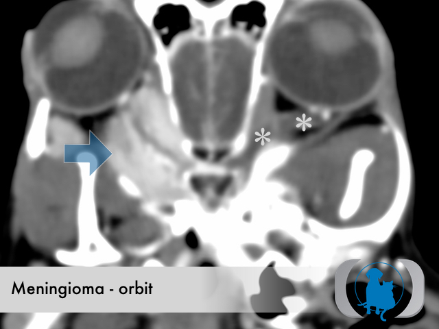 Meningioma orbital