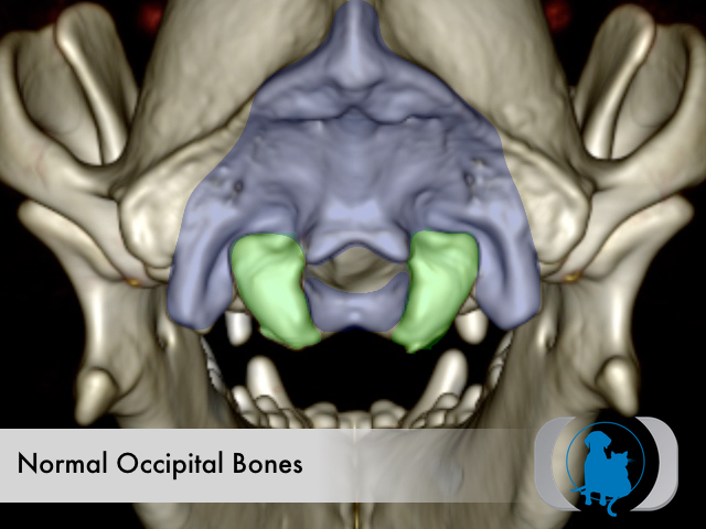 Normal occipital bones